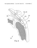 IMPLANTABLE TENDON PROTECTION SYSTEMS AND RELATED KITS AND METHODS diagram and image