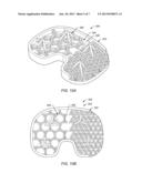 BONE IMPLANT INTERFACE SYSTEM AND METHOD diagram and image