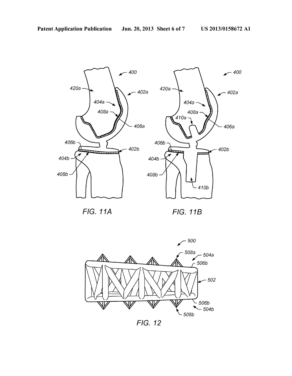 BONE IMPLANT INTERFACE SYSTEM AND METHOD - diagram, schematic, and image 07