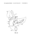 Anti-Leakage Prosthesis diagram and image