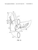 Anti-Leakage Prosthesis diagram and image