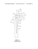 PROSTHETIC FEMORAL STEM FOR USE IN HIGH OFFSET HIP REPLACEMENT diagram and image