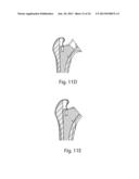 PROSTHETIC FEMORAL STEM FOR USE IN HIGH OFFSET HIP REPLACEMENT diagram and image