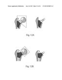 PROSTHETIC FEMORAL STEM FOR USE IN HIGH OFFSET HIP REPLACEMENT diagram and image