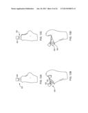 PROSTHETIC FEMORAL STEM FOR USE IN HIGH OFFSET HIP REPLACEMENT diagram and image