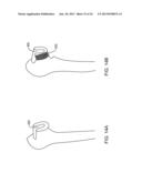 PROSTHETIC FEMORAL STEM FOR USE IN HIGH OFFSET HIP REPLACEMENT diagram and image