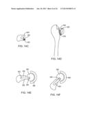 PROSTHETIC FEMORAL STEM FOR USE IN HIGH OFFSET HIP REPLACEMENT diagram and image