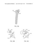 PROSTHETIC FEMORAL STEM FOR USE IN HIGH OFFSET HIP REPLACEMENT diagram and image