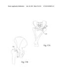 PROSTHETIC FEMORAL STEM FOR USE IN HIGH OFFSET HIP REPLACEMENT diagram and image