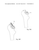 PROSTHETIC FEMORAL STEM FOR USE IN HIGH OFFSET HIP REPLACEMENT diagram and image