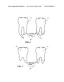 Integrated Support Device For Providing Temporary Primary Stability to     Dental Implants and Prosthesis, and Related Methods diagram and image