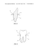 Integrated Support Device For Providing Temporary Primary Stability to     Dental Implants and Prosthesis, and Related Methods diagram and image