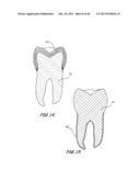 Integrated Support Device For Providing Temporary Primary Stability to     Dental Implants and Prosthesis, and Related Methods diagram and image