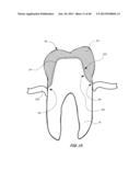 Integrated Support Device For Providing Temporary Primary Stability to     Dental Implants and Prosthesis, and Related Methods diagram and image