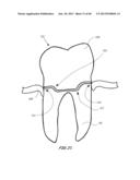 Integrated Support Device For Providing Temporary Primary Stability to     Dental Implants and Prosthesis, and Related Methods diagram and image