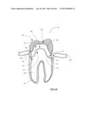 Integrated Support Device For Providing Temporary Primary Stability to     Dental Implants and Prosthesis, and Related Methods diagram and image