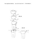 Integrated Support Device For Providing Temporary Primary Stability to     Dental Implants and Prosthesis, and Related Methods diagram and image