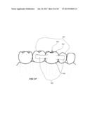 Integrated Support Device For Providing Temporary Primary Stability to     Dental Implants and Prosthesis, and Related Methods diagram and image