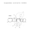 Integrated Support Device For Providing Temporary Primary Stability to     Dental Implants and Prosthesis, and Related Methods diagram and image