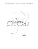 Integrated Support Device For Providing Temporary Primary Stability to     Dental Implants and Prosthesis, and Related Methods diagram and image