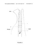 ENDOTRACHEAL TUBE FOR MECHANICAL VENTILATION diagram and image