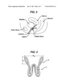 RESILIENT DEVICE diagram and image