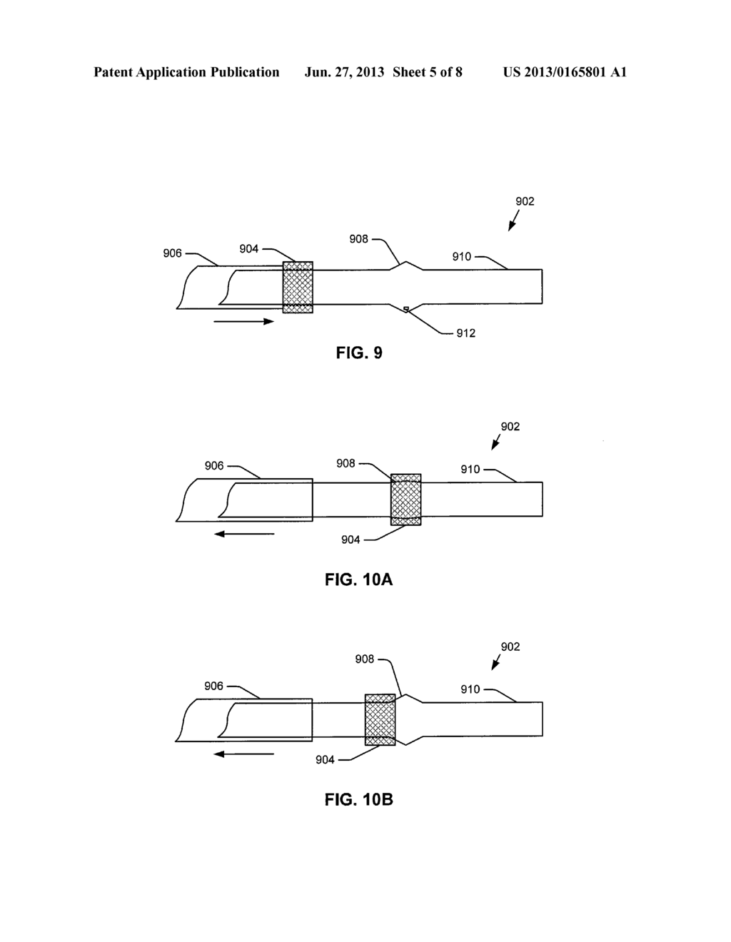 PASSIVE PRESSURE SENSOR FOR IMPLANTABLE LEAD - diagram, schematic, and image 06