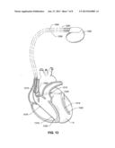 PASSIVE PRESSURE SENSOR FOR IMPLANTABLE LEAD diagram and image