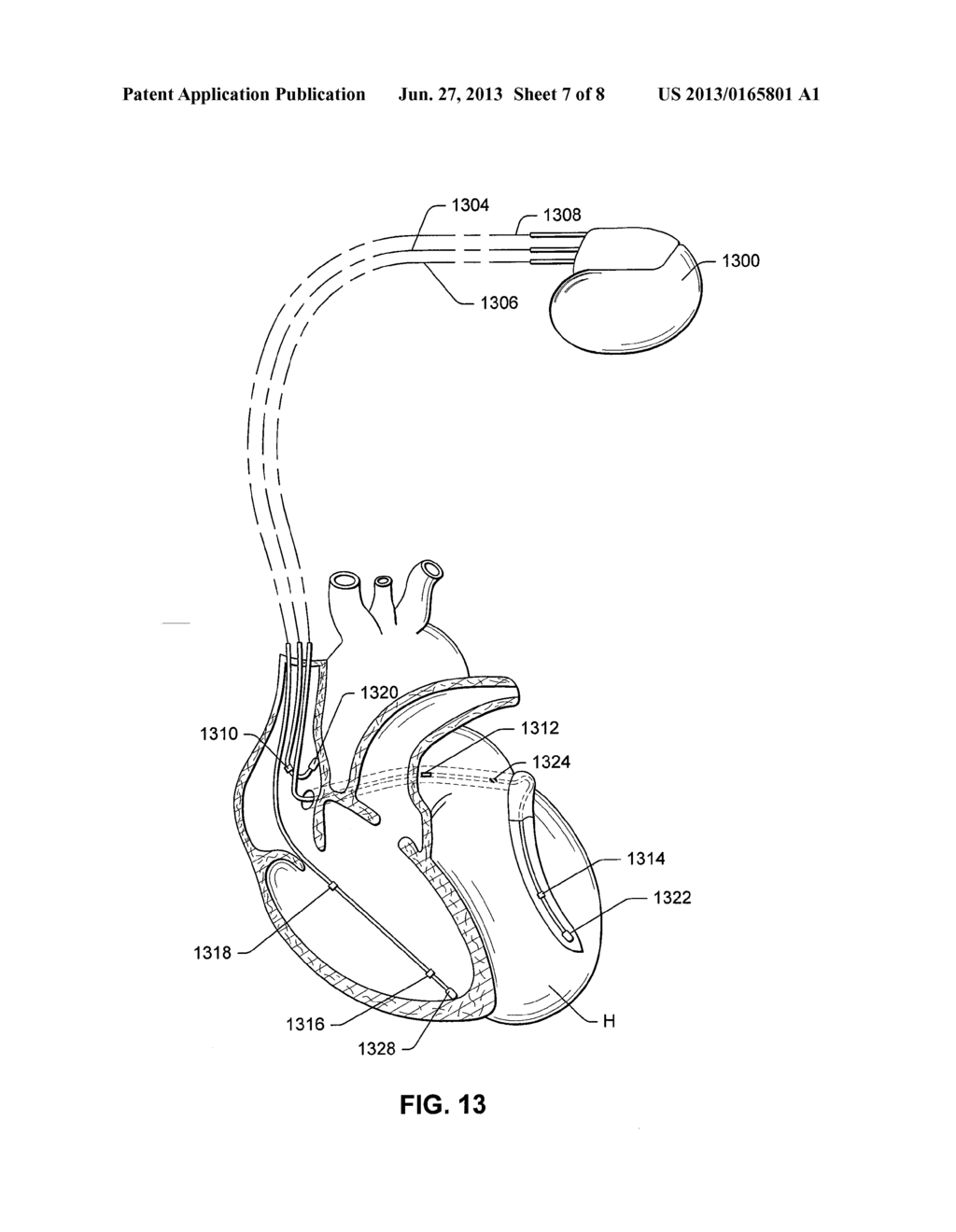 PASSIVE PRESSURE SENSOR FOR IMPLANTABLE LEAD - diagram, schematic, and image 08