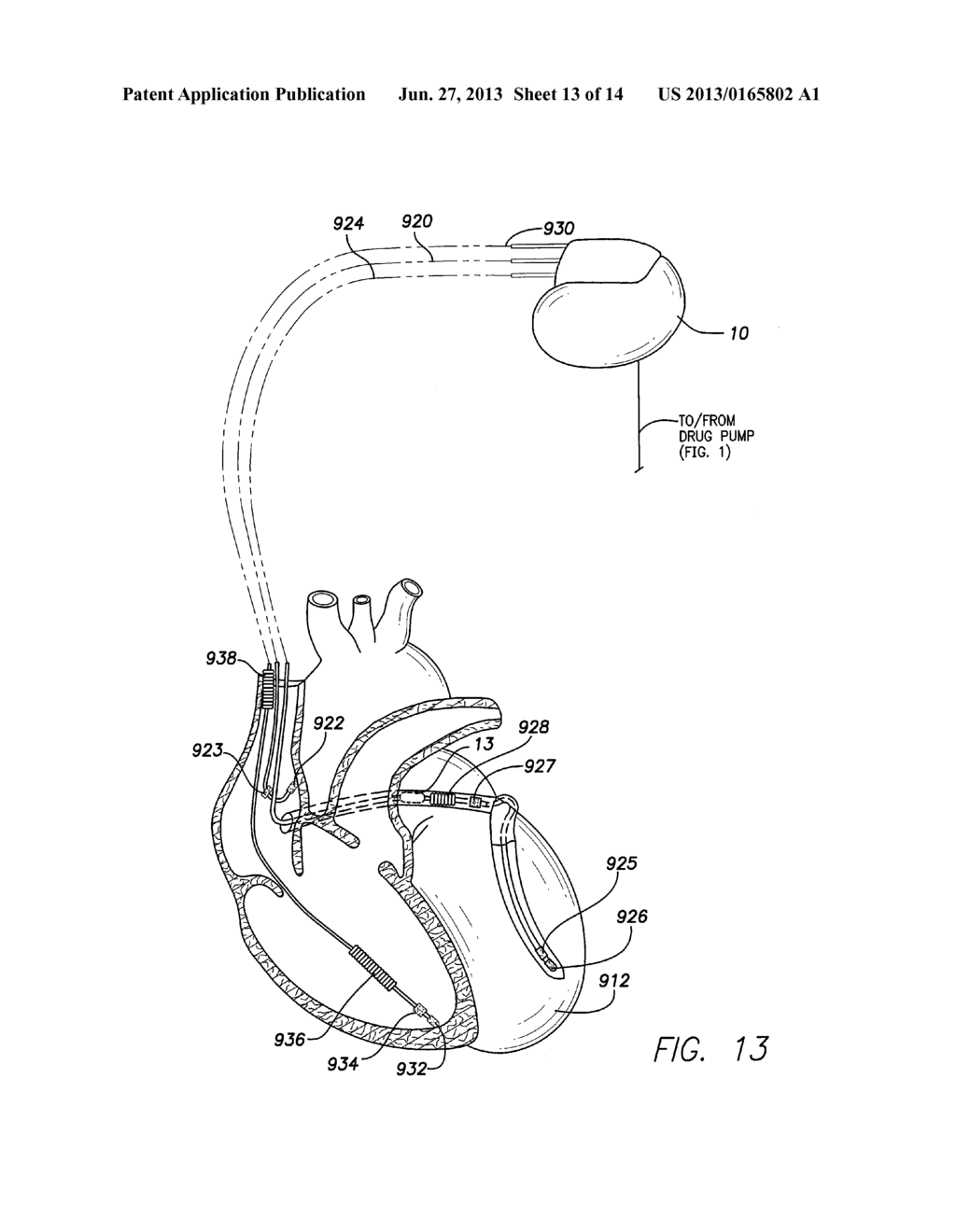 SYSTEM AND METHOD FOR DISCRIMINATING HYPERVOLEMIA, HYPOVOLEMIA  AND     EUVOLEMIA USING AN IMPLANTABLE MEDICAL DEVICE - diagram, schematic, and image 14