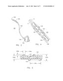 Rotate-to-Advance Catheterization System diagram and image