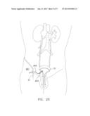 Rotate-to-Advance Catheterization System diagram and image