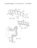 Rotate-to-Advance Catheterization System diagram and image