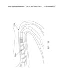 Rotate-to-Advance Catheterization System diagram and image