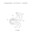 Rotate-to-Advance Catheterization System diagram and image