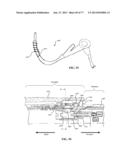 Rotate-to-Advance Catheterization System diagram and image