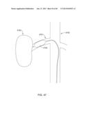 METHODS AND APPARATUSES FOR REMODELING TISSUE OF OR ADJACENT TO A BODY     PASSAGE diagram and image