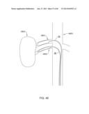 METHODS AND APPARATUSES FOR REMODELING TISSUE OF OR ADJACENT TO A BODY     PASSAGE diagram and image