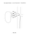 METHODS AND APPARATUSES FOR REMODELING TISSUE OF OR ADJACENT TO A BODY     PASSAGE diagram and image