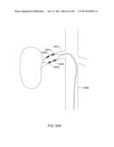 METHODS AND APPARATUSES FOR REMODELING TISSUE OF OR ADJACENT TO A BODY     PASSAGE diagram and image