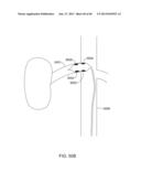 METHODS AND APPARATUSES FOR REMODELING TISSUE OF OR ADJACENT TO A BODY     PASSAGE diagram and image