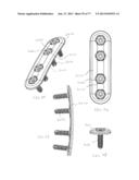 BONE PLATE SYSTEM AND METHOD diagram and image