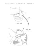 TENSIONABLE KNOTLESS ANCHOR SYSTEMS AND METHODS OF TISSUE REPAIR diagram and image