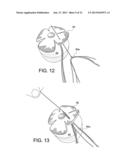 TENSIONABLE KNOTLESS ANCHOR SYSTEMS AND METHODS OF TISSUE REPAIR diagram and image