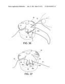 TENSIONABLE KNOTLESS ANCHOR SYSTEMS AND METHODS OF TISSUE REPAIR diagram and image