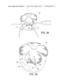 TENSIONABLE KNOTLESS ANCHOR SYSTEMS AND METHODS OF TISSUE REPAIR diagram and image