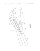 WRIST FUSION PLATE diagram and image