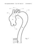 HYBRID AORTIC ARCH REPLACEMENT diagram and image