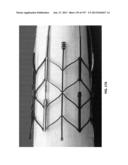 Actively Controllable Stent, Stent Graft, Heart Valve and Method of     Controlling Same diagram and image