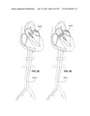 Actively Controllable Stent, Stent Graft, Heart Valve and Method of     Controlling Same diagram and image